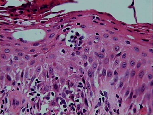 Fig.12 Microabsceso en estrato superior. - <div style=